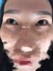 -爱莎扁平疣·汗管瘤·斑痣中心