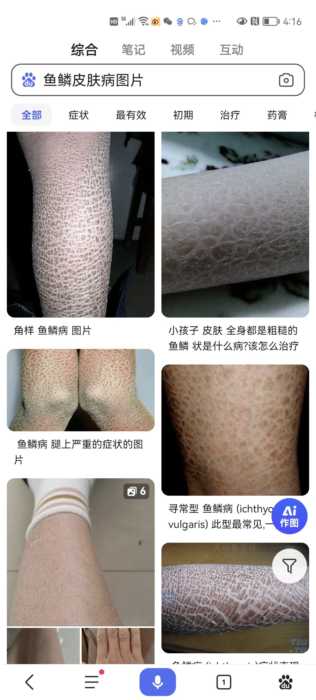 鱼鳞皮肤病可以根治吗图片