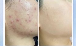 -美肤盾祛痘·问题肌头疗管理中心