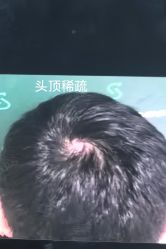 -北京雍禾植发医院