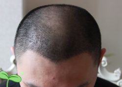 -大麦微针植发丨全国连锁