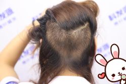 -大麦微针植发丨全国连锁