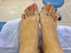 -派恩宜灰指甲鸡眼嵌甲手足癣