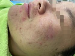 -苗医生0感科技祛痘