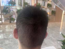 -碧莲盛·不剃发植发