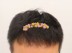 -大麦微针植发全国连锁