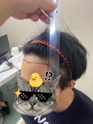 -大麦微针植发全国连锁