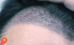 -大麦微针植发丨全国连锁