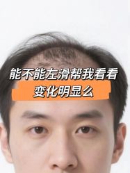 -大麦微针植发丨全国连锁