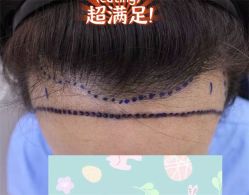 -大麦微针植发全国连锁
