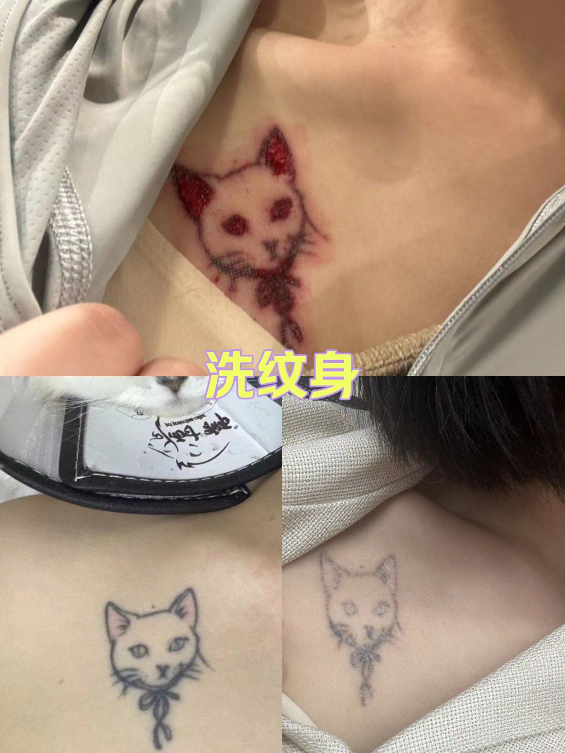 皮秒洗纹身记录有点狠啊[得意][得意][得意]