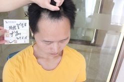 点击看大图 -大麦微针植发丨全国连锁