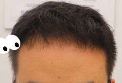 -大麦微针植发全国连锁