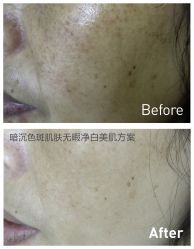 脸部抗衰-光SPA科技美肤