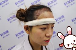 -大麦微针植发丨全国连锁