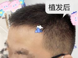 -大麦微针植发全国连锁