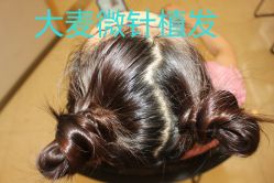 -大麦微针植发丨全国连锁