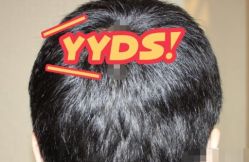 -大麦微针植发丨全国连锁