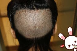 点击看大图 -大麦微针植发丨全国连锁