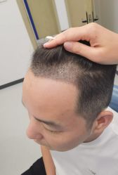 -大麦微针植发全国连锁