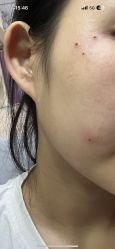 -北京美痣堂古方祛痣斑疣瘊