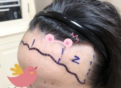 -大麦微针植发全国连锁