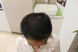 -大麦微针植发丨全国连锁