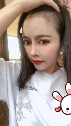 点击看大图 -大麦微针植发丨全国连锁