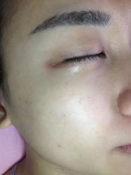 -美丽人生祛斑扁平疣汗管瘤中心