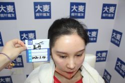-大麦微针植发丨全国连锁