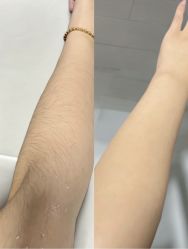 -薇兰专业脱毛连锁机构