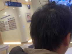 -大麦微针植发全国连锁