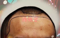 -大麦微针植发全国连锁