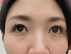 体验后-爱莎扁平疣·汗管瘤·斑痣中心