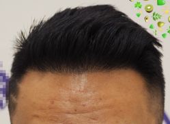 -大麦微针植发全国连锁