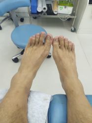 -派恩宜灰指甲鸡眼嵌甲手足癣