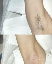 -薇兰专业脱毛连锁机构