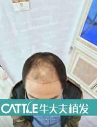-牛大夫植发