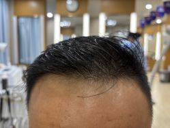 -大麦微针植发全国连锁