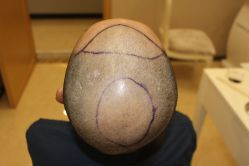 -大麦微针植发丨全国连锁