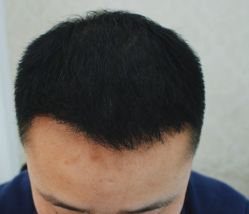 -大麦微针植发全国连锁
