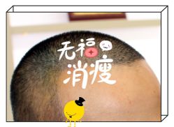 -大麦微针植发全国连锁