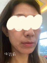 体验前-青岛诺德医学美容医院