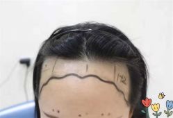 点击看大图 -大麦微针植发全国连锁
