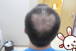 点击看大图 -大麦微针植发丨全国连锁