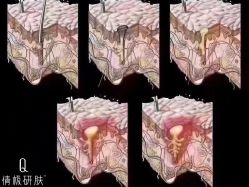 -倩极·精研痘敏肌管理