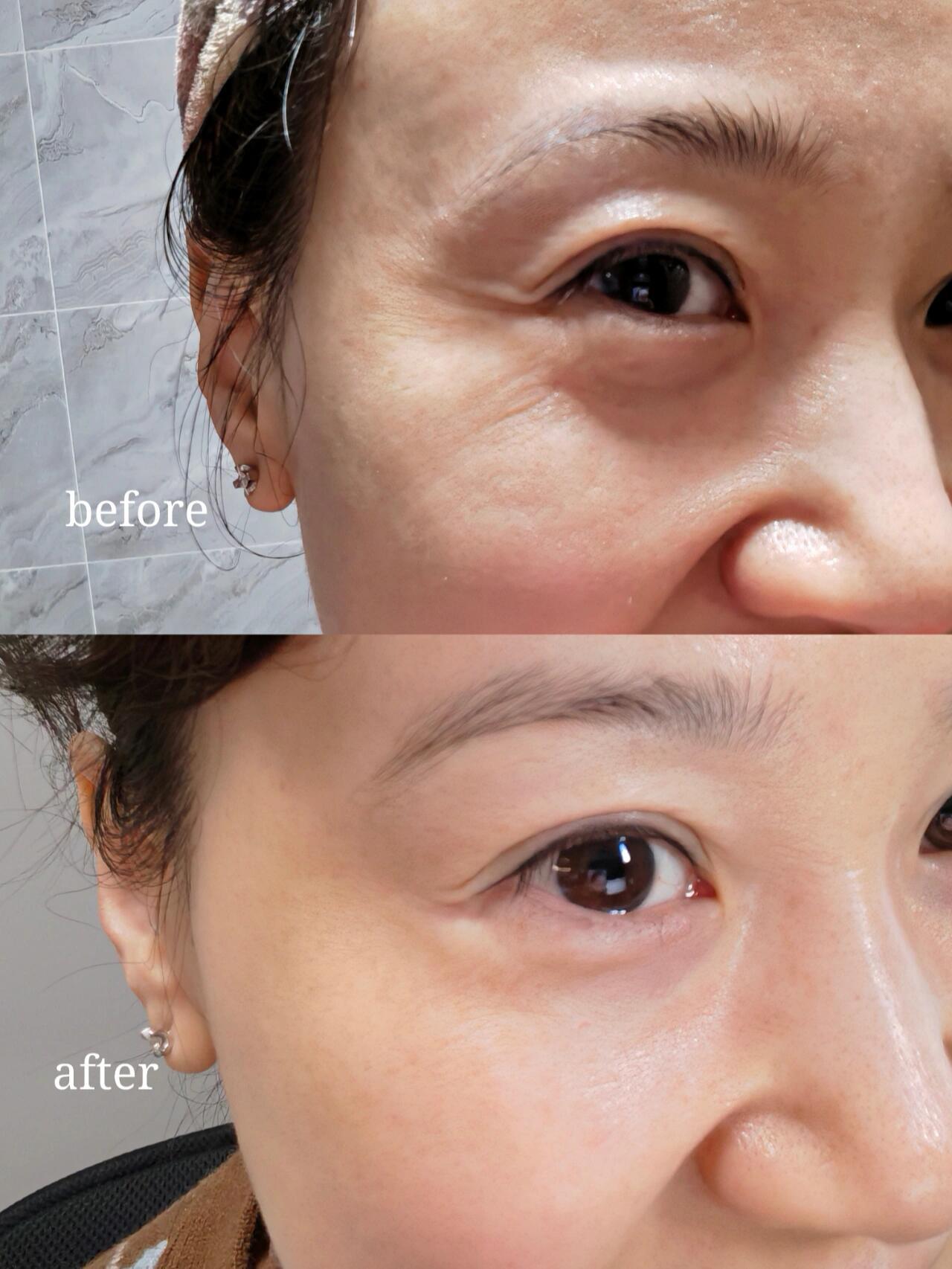 除皱针第三天的效果对比图!