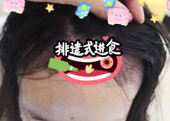 -大麦微针植发全国连锁