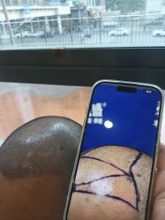 -碧莲盛·不剃发植发