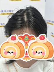 -大麦微针植发丨全国连锁